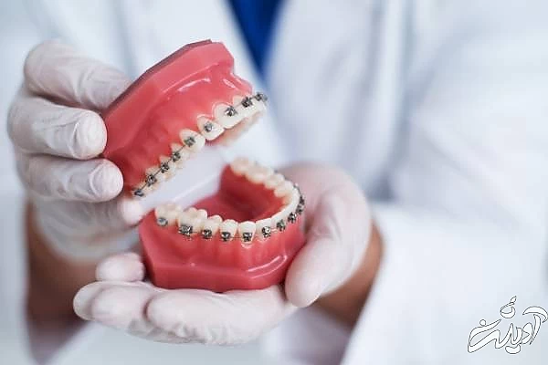 اثرات بد ارتودنسی معایب ارتودنسی